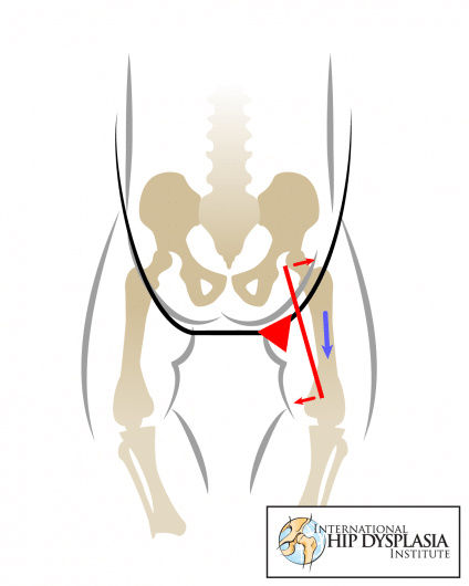 BAD.  Notice how the forces of gravity traction the joint downward. 