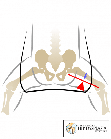 Good support all the way to the knee joint helps the hip develop properly. 